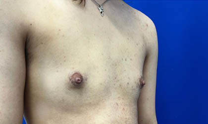 Female To Male case #7852