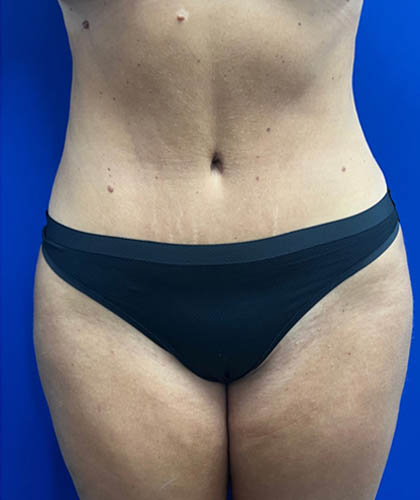 Tummy Tuck case #7873