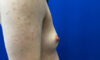 Female To Male case #7852