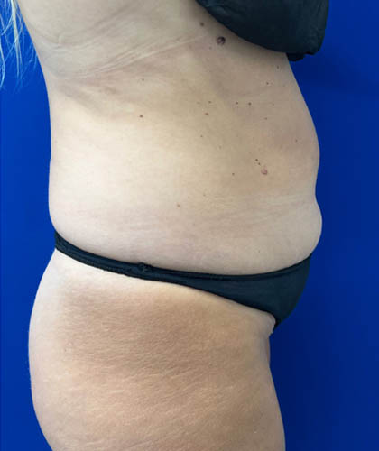 Tummy Tuck case #7873