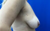 Breast Implants and Lift case #7874