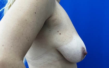 Breast Implants and Lift case #7874
