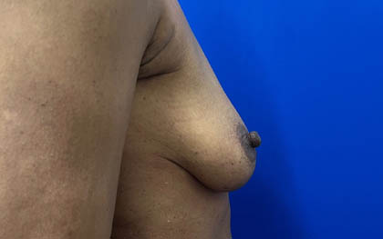 Breast Augmentation case #7831