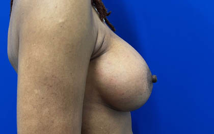 Breast Augmentation case #7831