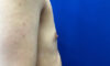 Female To Male case #7852