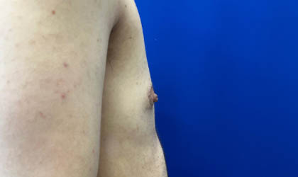 Female To Male case #7852