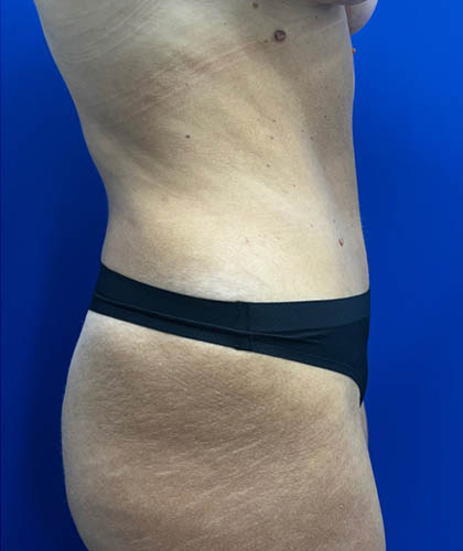 Tummy Tuck case #7873