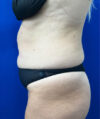 Tummy Tuck case #7873