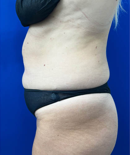 Tummy Tuck case #7873