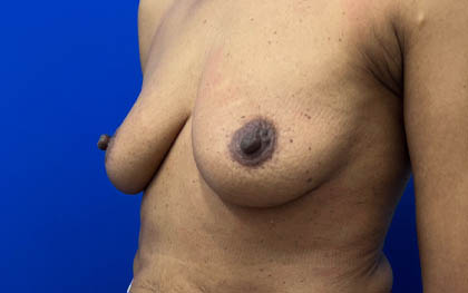 Breast Augmentation case #7831