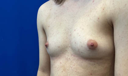 Female To Male case #7852
