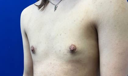 Female To Male case #7852