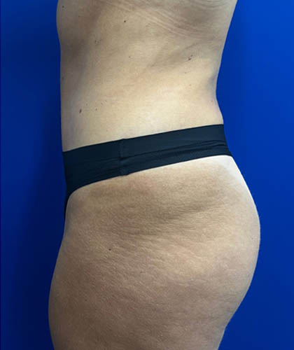 Tummy Tuck case #7873