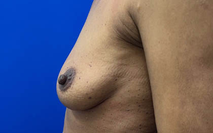 Breast Augmentation case #7831
