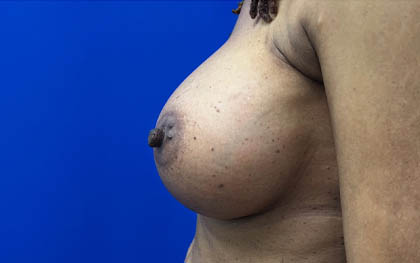 Breast Augmentation case #7831