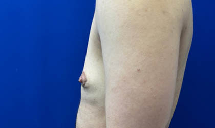 Female To Male case #7852