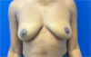 Breast Augmentation case #8702