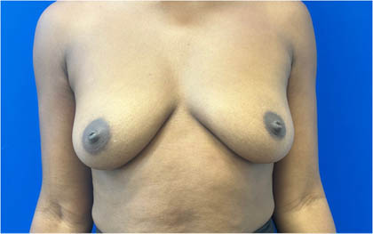 Breast Augmentation case #8702