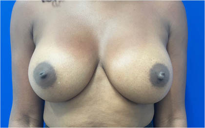 Breast Augmentation case #8702
