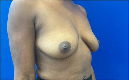 Breast Augmentation case #8702