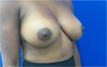 Breast Augmentation case #8702