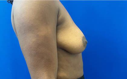 Breast Augmentation case #8702