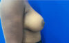 Breast Augmentation case #8702
