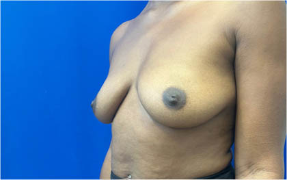 Breast Augmentation case #8702