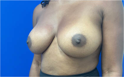 Breast Augmentation case #8702