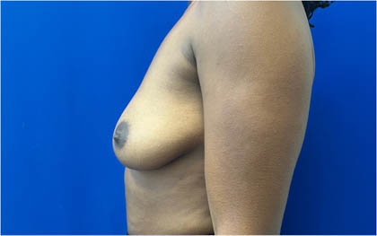 Breast Augmentation case #8702