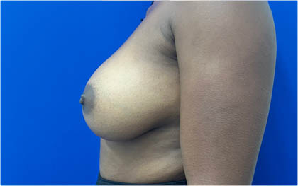 Breast Augmentation case #8702