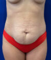 Liposuction case #9666