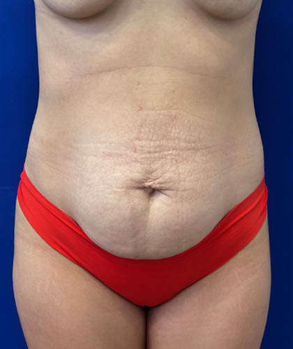 Liposuction case #9666