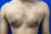 Gynecomastia case #9675