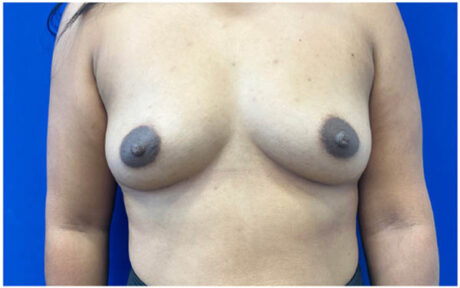 Breast Augmentation case #9540
