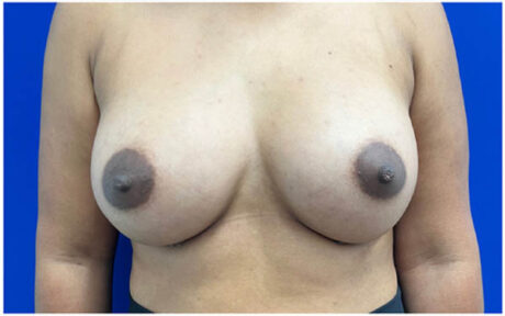 Breast Augmentation case #9540