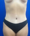 Liposuction case #9666