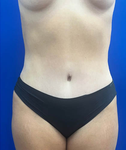 Liposuction case #9666