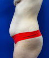 Liposuction case #9666