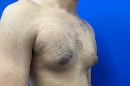 Gynecomastia case #9675