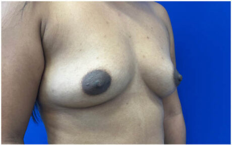 Breast Augmentation case #9540