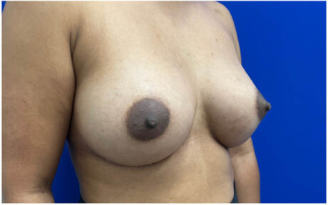 Breast Augmentation case #9540