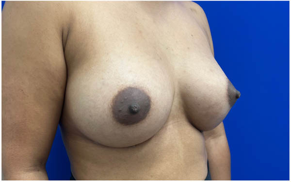 Breast Augmentation case #9540