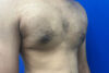Gynecomastia case #9675