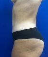 Liposuction case #9666