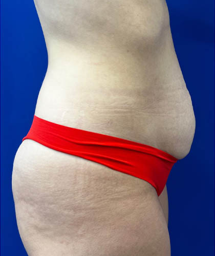 Liposuction case #9666