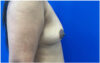 Breast Augmentation case #9540