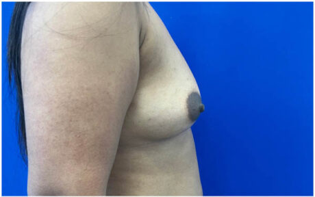 Breast Augmentation case #9540