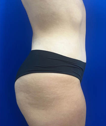 Liposuction case #9666