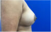 Breast Augmentation case #9540